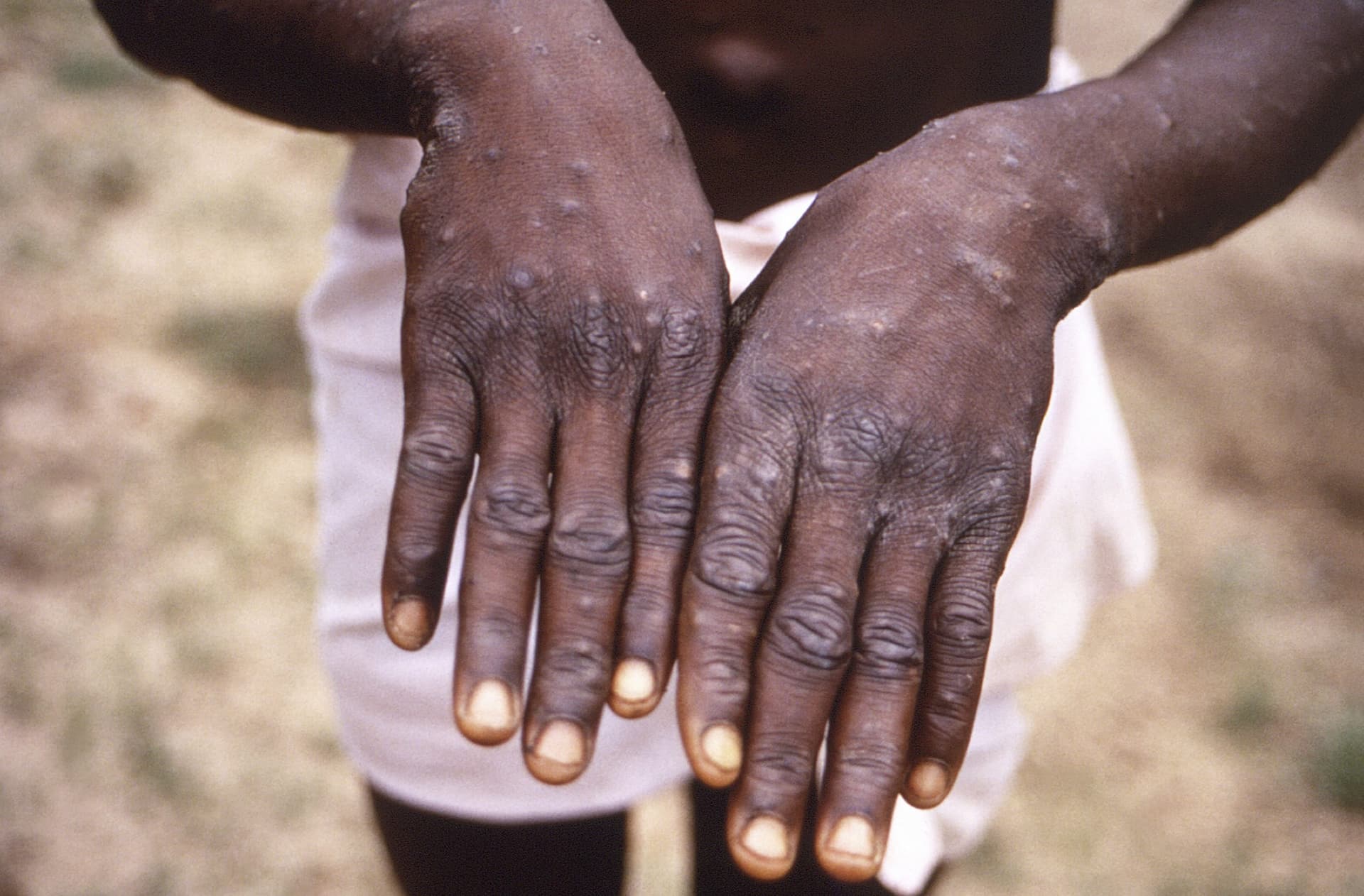 Monkeypox Alert: मंकीपॉक्स को लेकर कानपुर में अलर्ट, हैलट अस्पताल में बना अलग वार्ड बने