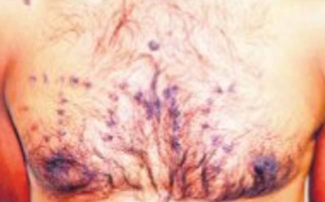 सिगरेट से दाग कर टीएमसी लिखने का मामला : हाइकोर्ट जायेगी भाजपा