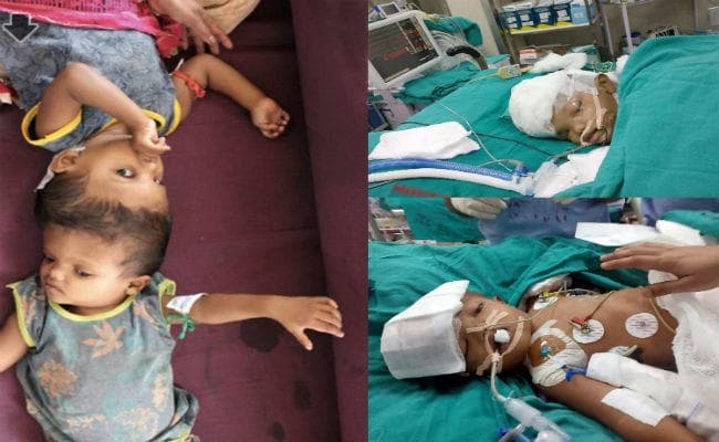 आपस में सिर से जुड़े जुड़वां बच्चों को अलग किया गया, 16 घंटे तक चली सर्जरी