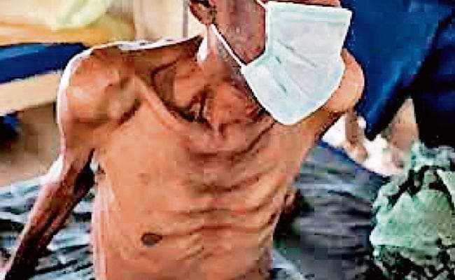 झारखंड : राज्य में सबसे अधिक एनिमिक पुरुष लोहरदगा में, देखें आंकड़ा