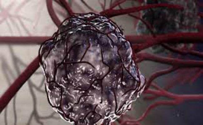 रिसर्चर्स ने आक्रामक ट्यूमर की पहचान के लिए नयी तकनीक विकसित की