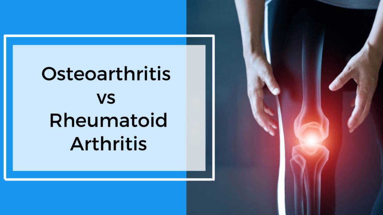 खराब लाइफ स्टाइल, जंक फूड…. बढ़ा रहा Osteoarthritis और Rheumatoid Arthritis के मरीज