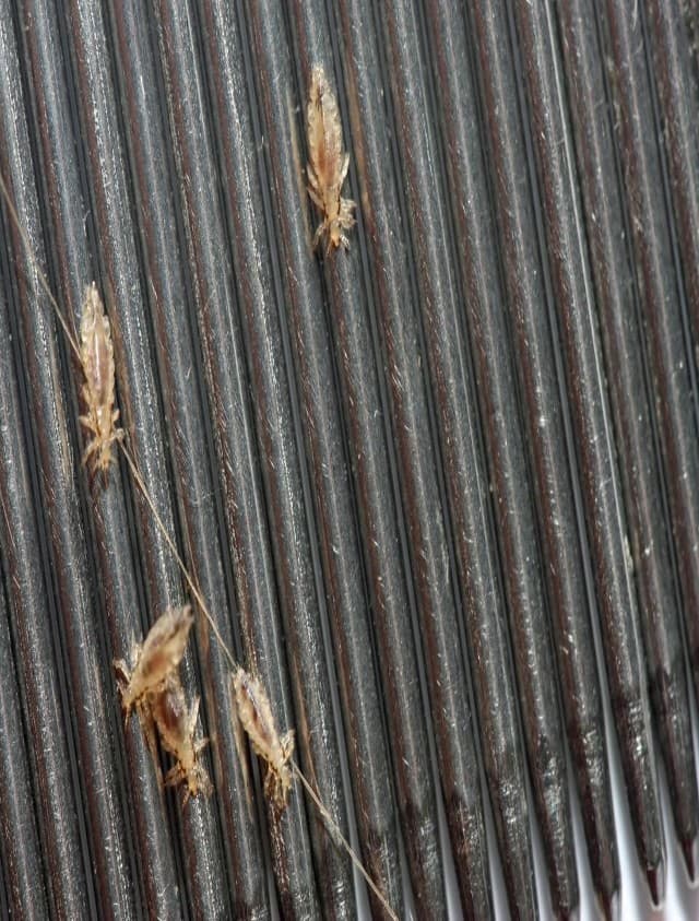 Head Lice Removal Home Remedies: इस तरकीब से घर पर ही निकाले सिर में पड़े जुएं