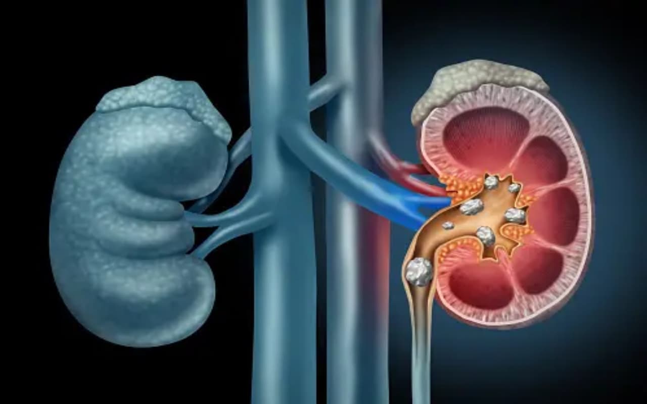 Health: जरूरत से ज्यादा कैल्शियम की खुराक क्या बनती है किडनी स्टोन का कारण, जानें यहां