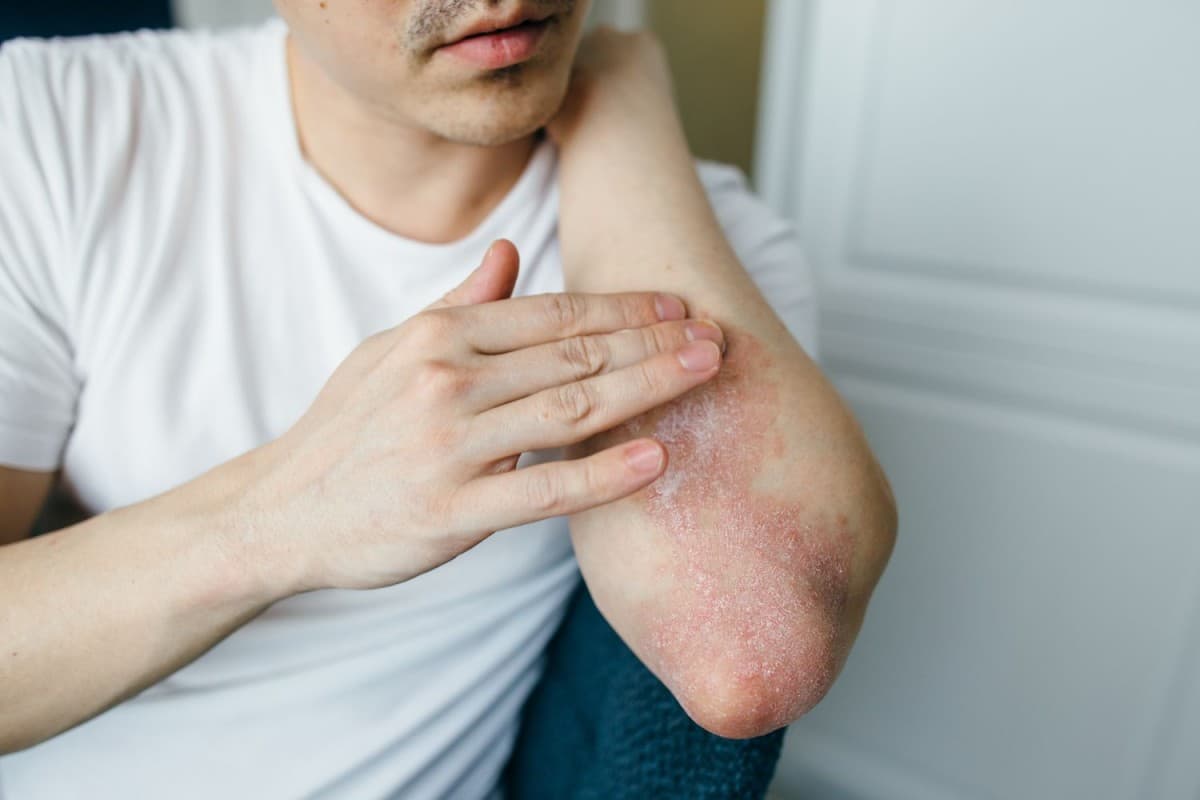 Ayurvedic Treatment For Itchy: खुजली दूर करना है तो आजमा लें ये आयुर्वेदिक उपाय
