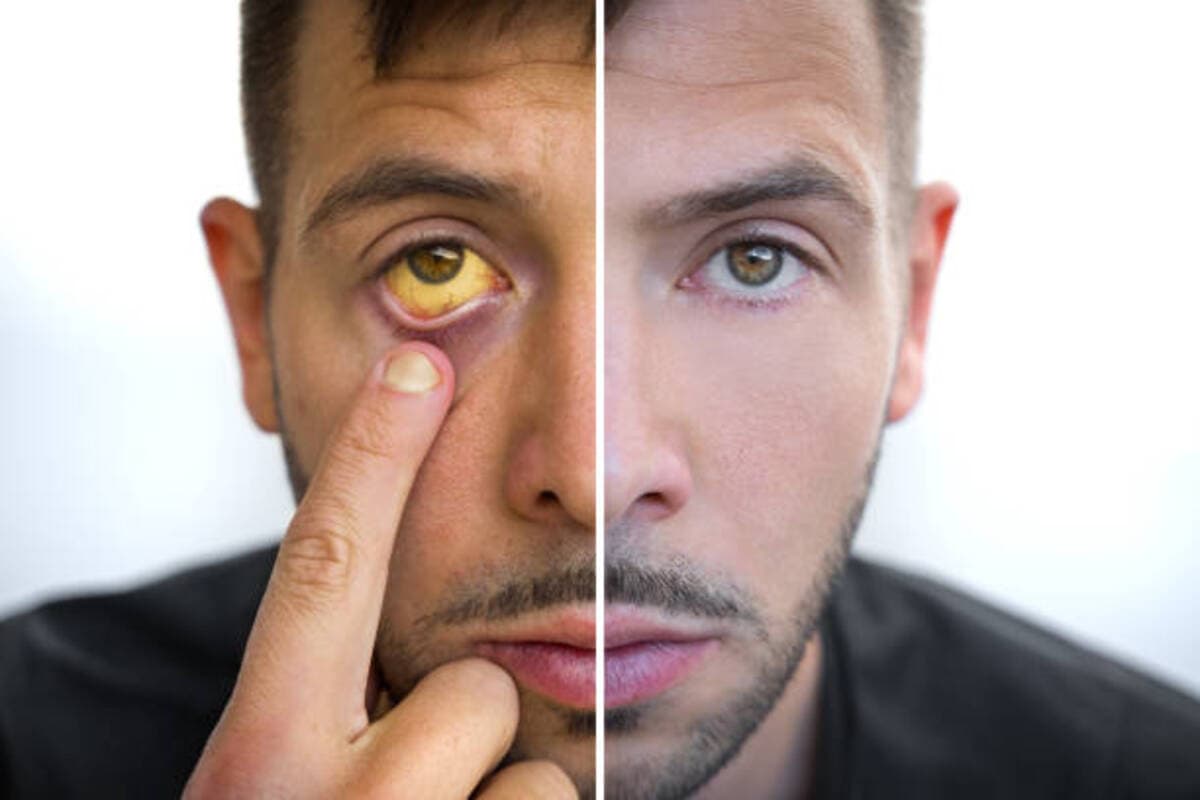 Black Jaundice Black Jaundice