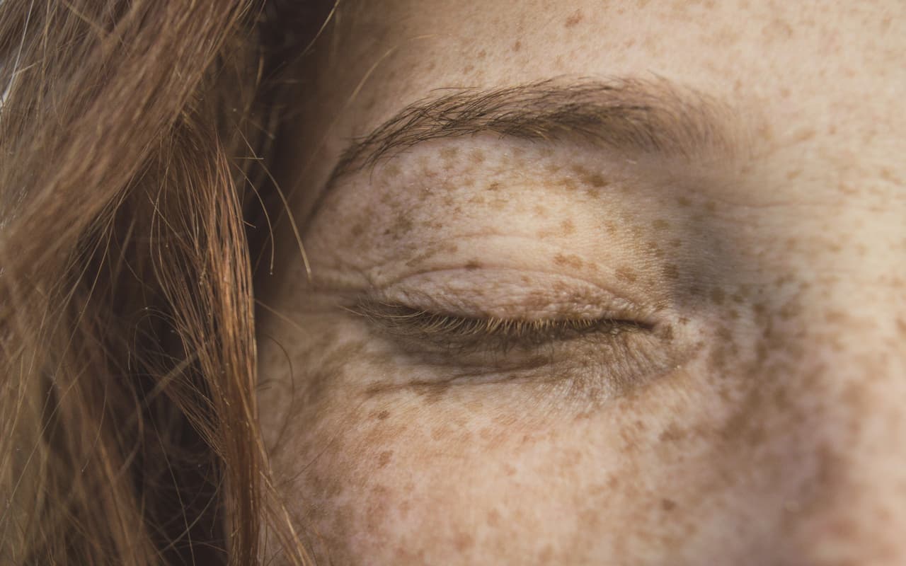 Skin Care Tips: झाइयों से छुटकारा पाने का ये है सबसे आसान तरीका, आप भी जानें
