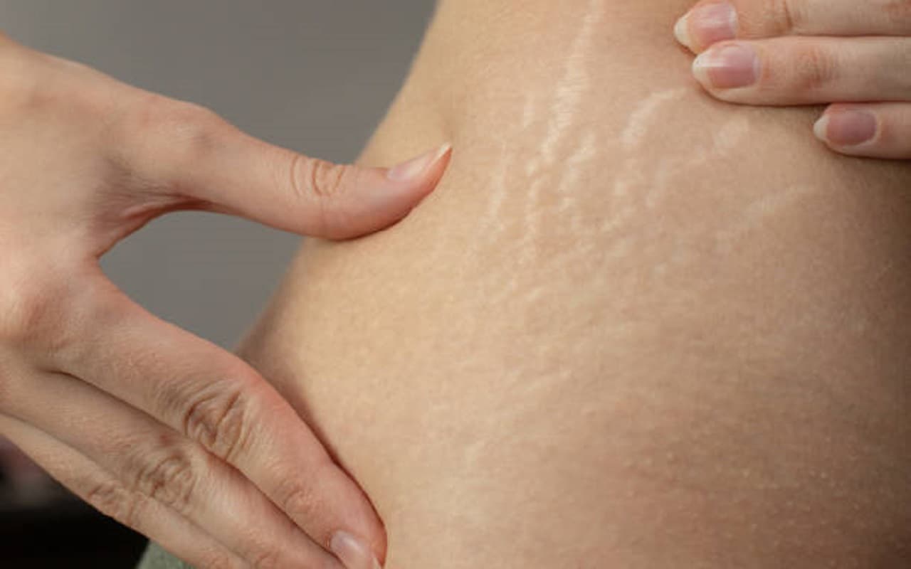 Skin Care Tips: स्ट्रेच मार्क्स की समस्या कम करेंगे ये घरेलू उपाय