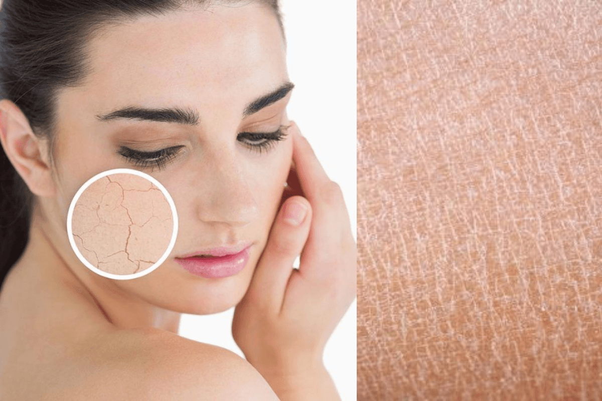 Dry Skin Tips: अगर आपका भी है ड्राई स्किन ताे इन चाीजों को करे दें अलविदा