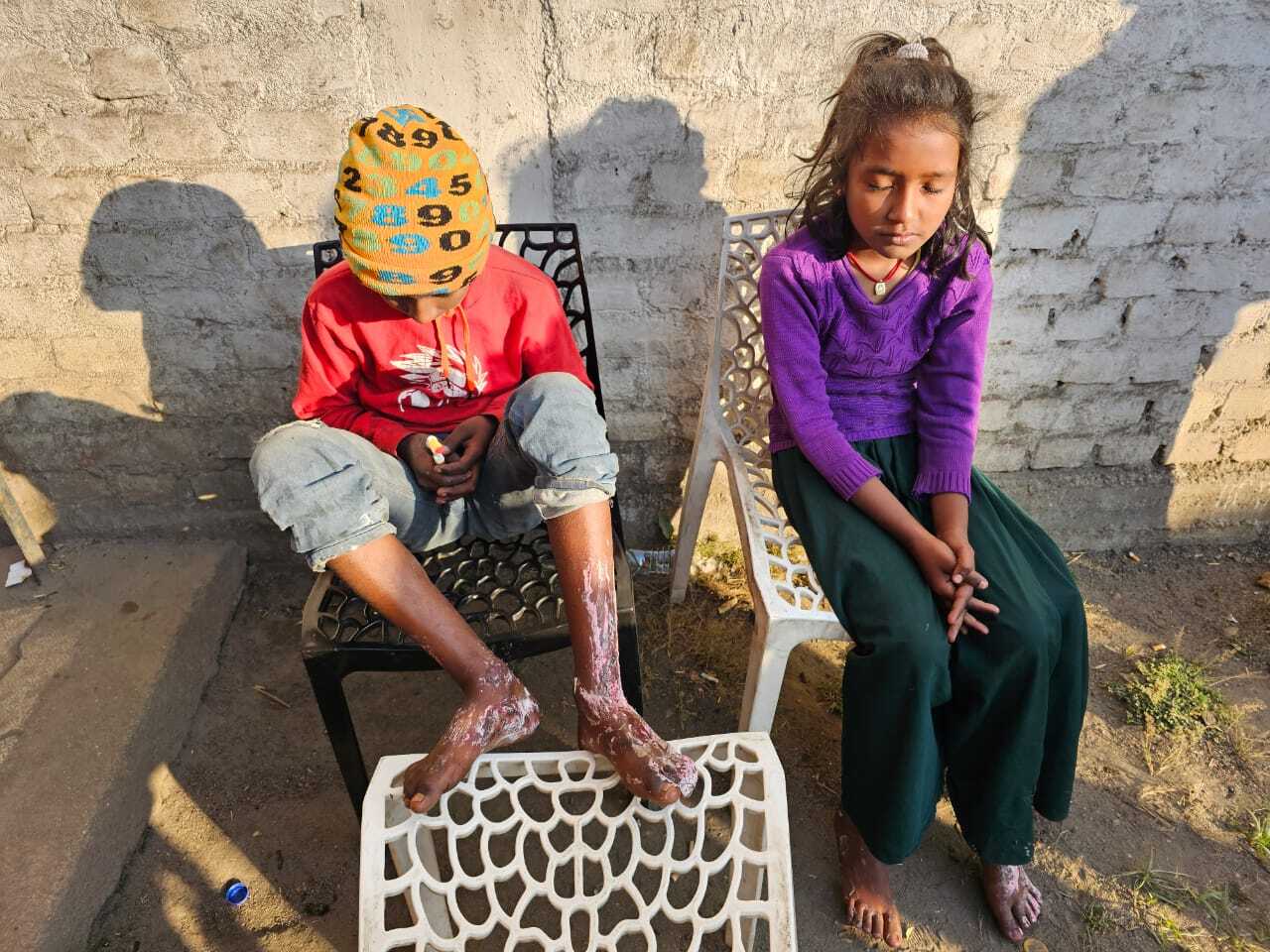 मोमबत्ती से घर में लगी आग, दो बच्चे झूलसे