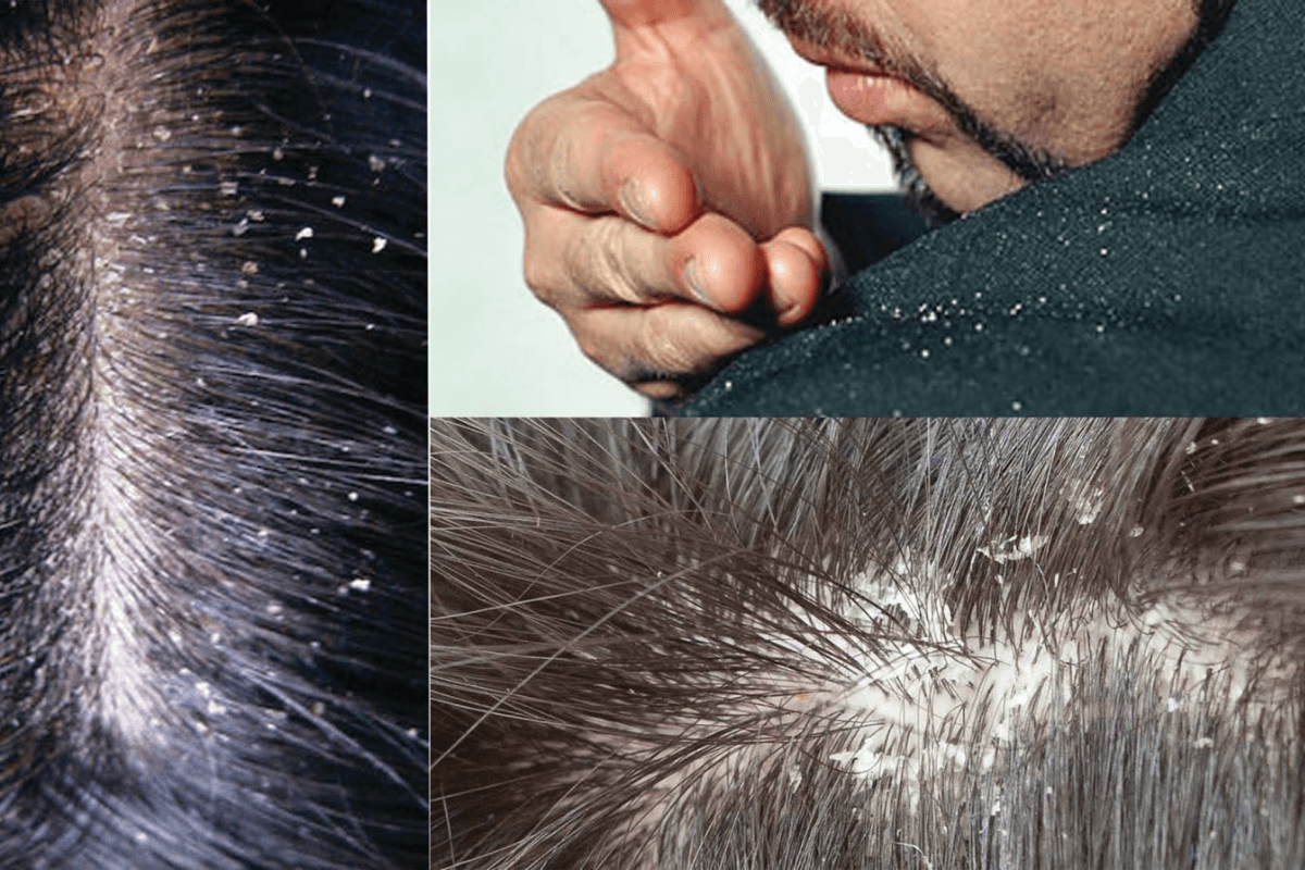 Curd For Dandruff: स्कैल्प पर जमे हुए डैंड्रफ को हटाने के लिए करें दही का इस्तेमाल, जानें सही तरीका