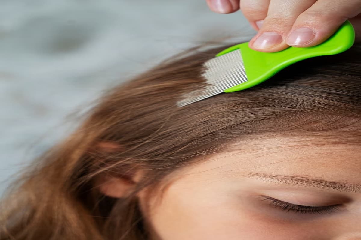 Hair Care Tips: जुएं पर कहर बनकर टूटेंगे ये देसी इलाज, घरेलू ट्रिक्स कर देंगी सफाया