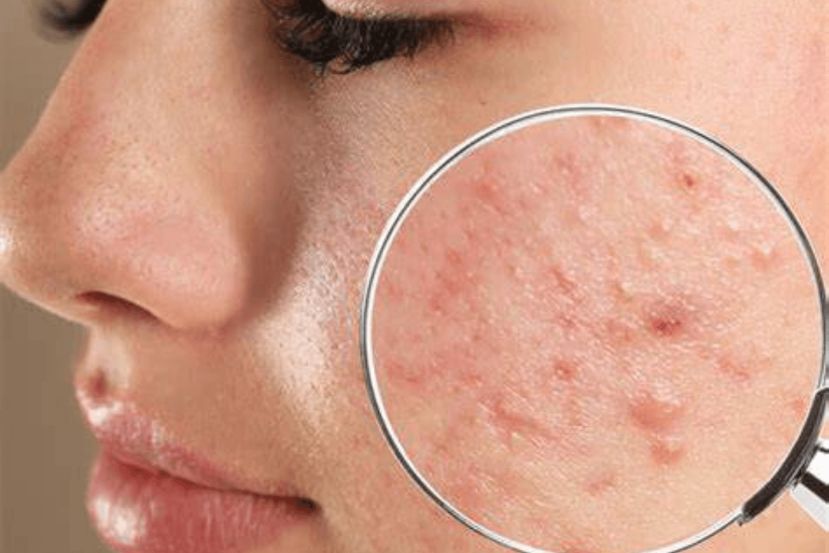 Skincare Tips: स्किन ब्रेकआउट्स से हैं परेशान? ये टिप्स देंगे आपको साफ-सुथरी त्वचा