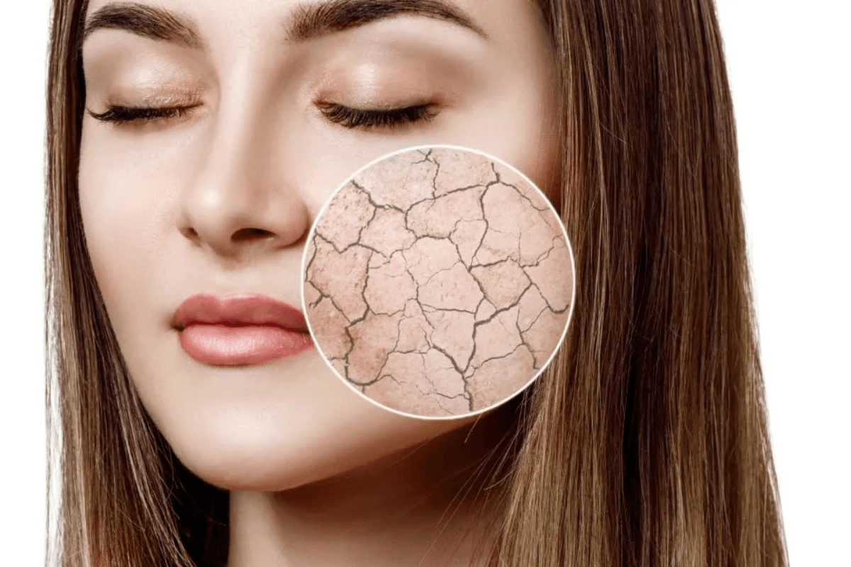 Dry Skin Home Remedies: रूखी स्किन का इलाज है किचन में छुपा, जानिए 5 देसी उपाय