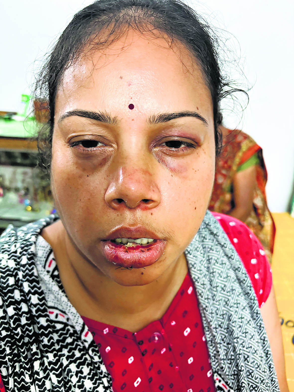 Jamshedpur News : टेल्को: पिता की देखभाल कर रही महिला से मारपीट, भाइयों के खिलाफ दर्ज करायी प्राथमिकी