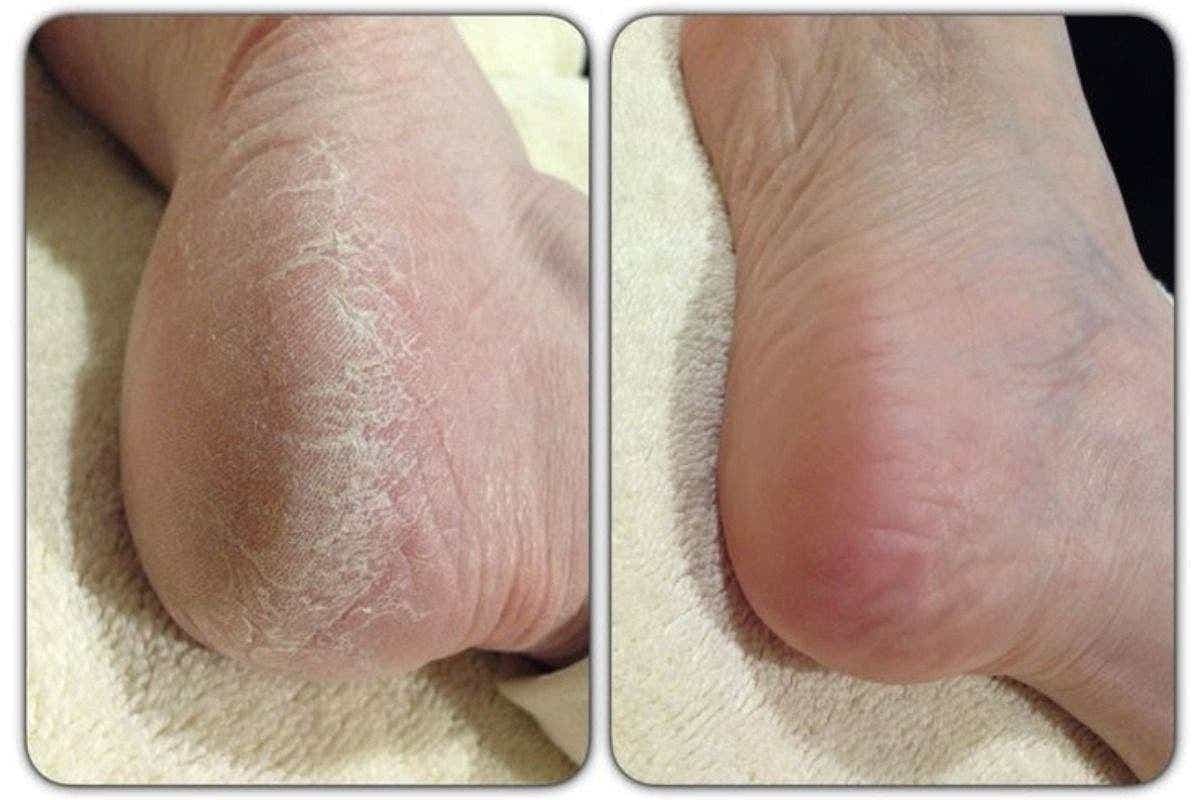 Cracked Heels Remedies