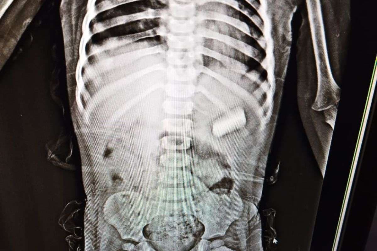 Baby girl abdominal x-ray