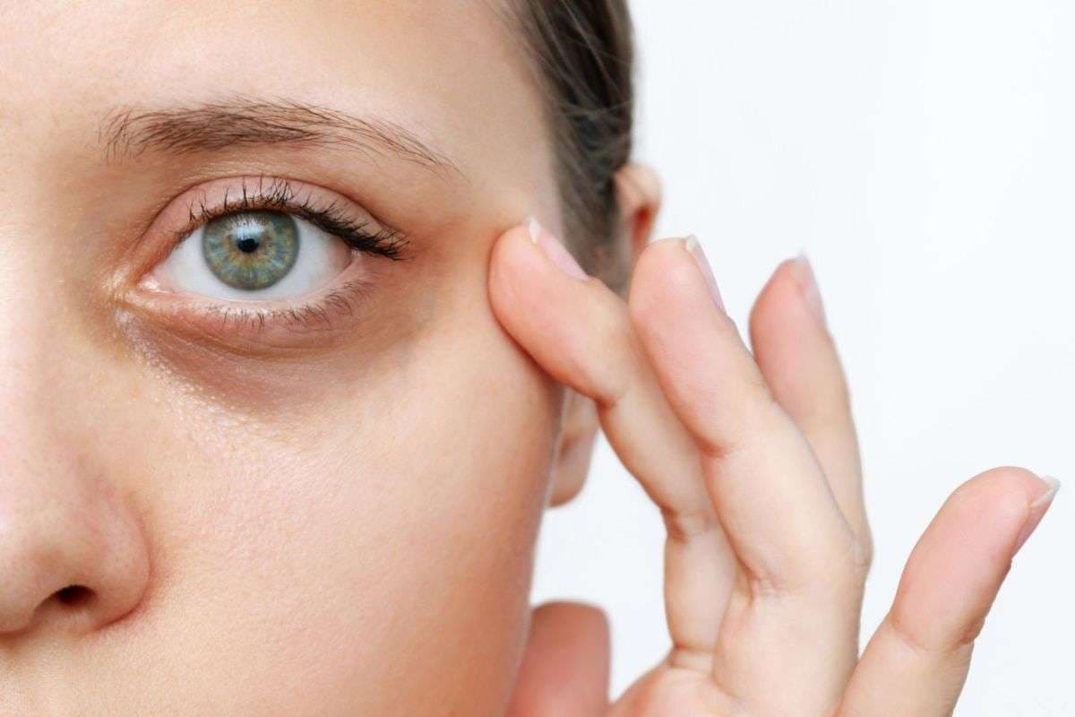 Dark Circle Tips: हफ्ते भर में दूर होंगे डार्क सर्कल, तुरंत करना होगा ये घरेलू उपाय