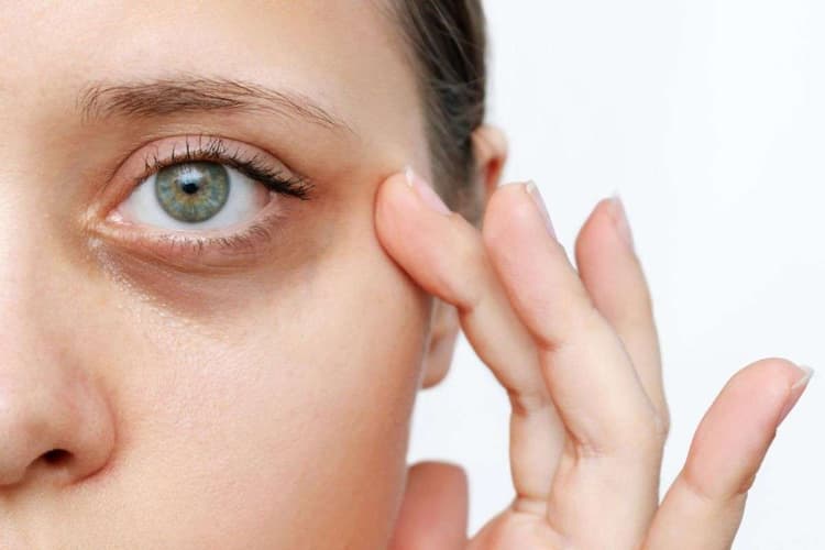 Dark Circle Tips: हफ्ते भर में दूर होंगे डार्क सर्कल, तुरंत करना होगा ये घरेलू उपाय