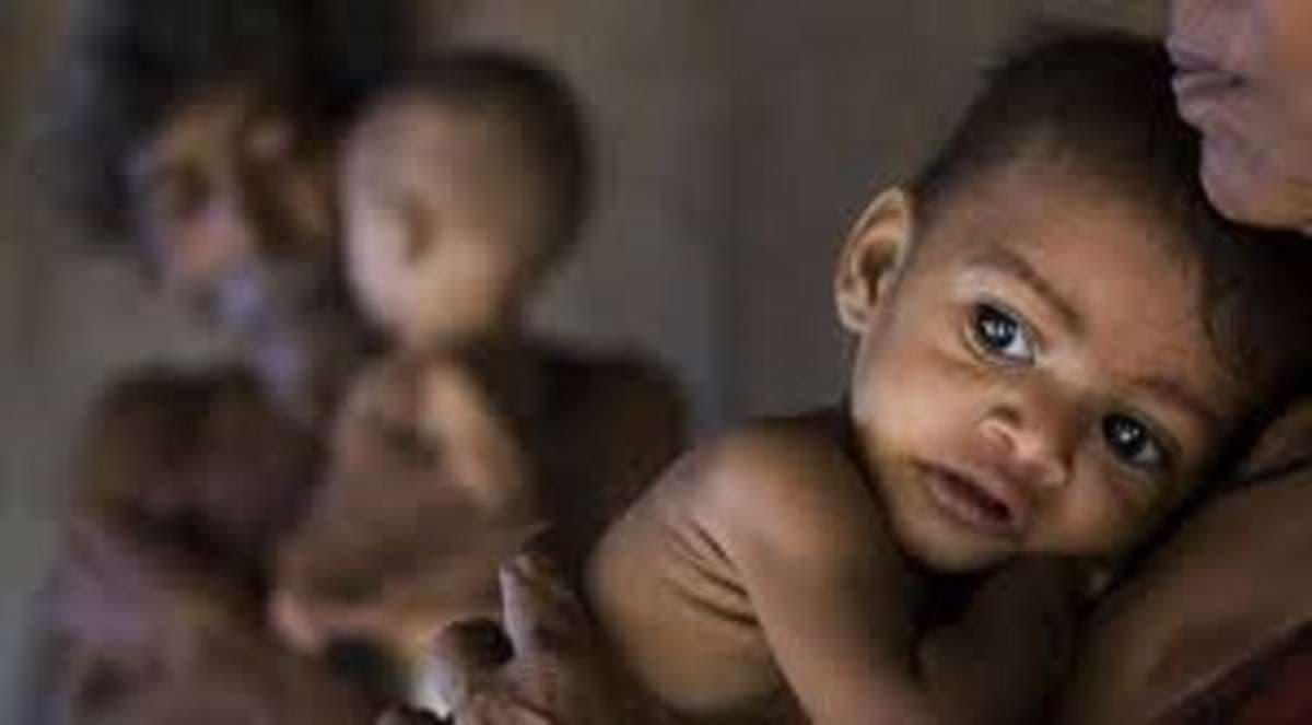 Malnutrition: कुपोषण से निपटने के लिए राष्ट्रीय स्तर पर भागीदारी जरूरी