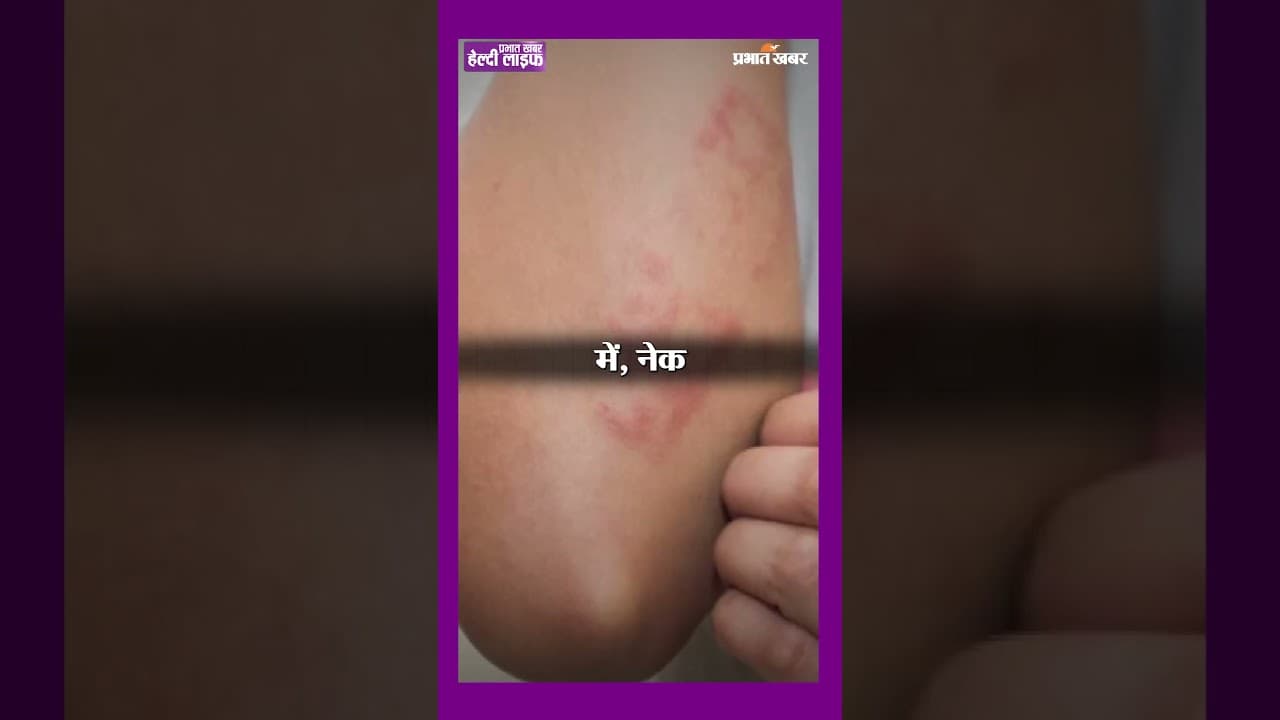 क्यों होता है Fungal Infection? | जानिए Causes, Diet और Prevention | Healthy Life Season 1
