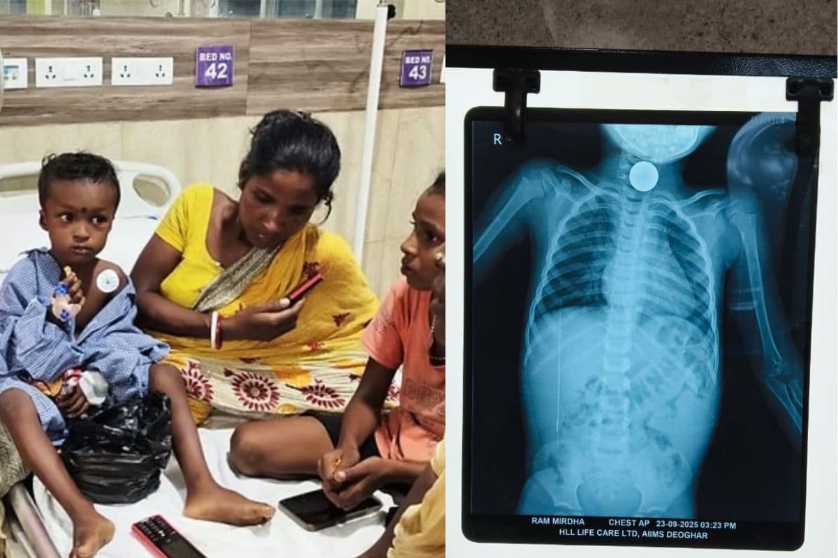 देवघर AIIMS के डॉक्टरों का कमाल, 15 मिनट में निकाला बच्चे के गले में फंसा 10 रुपये का सिक्का