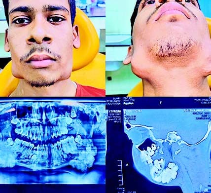 पटना में डाक्टरों ने किया अनोखा ऑपरेशन, 17 साल के लड़के के जबड़े से निकाले 82 दांत