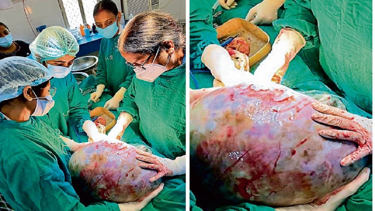 नालंदा मेडिकल कॉलेज अस्पताल के डॉक्टरों ने महिला के पेट से निकाला 15 किलो का ट्यूमर, घंटों तक चला ऑपरेशन