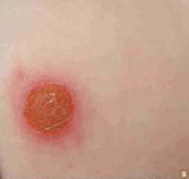 जलती सिगरेट से भाजपा समर्थक के सीने पर लिख दिया टीएमसी