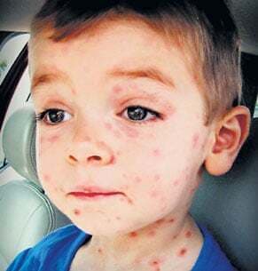 होमियोपैथी है खसरे में कारगर