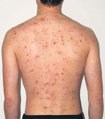 कैसे बचें मिजिल्स और चिकेन पॉक्स से