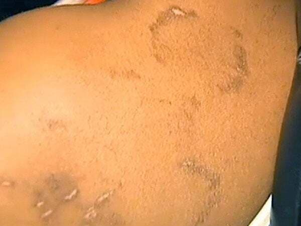 बिहारः छात्र के शरीर में शिक्षक ने जगह जगह दांत काटा