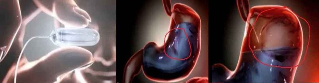 आपके मोटापे को कम करेगा गुब्बारा: रिसर्च