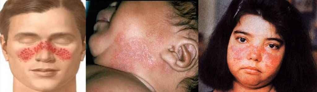 इम्यून सिस्टम से जुड़ा जटिल रोग है ‘ल्यूपस’