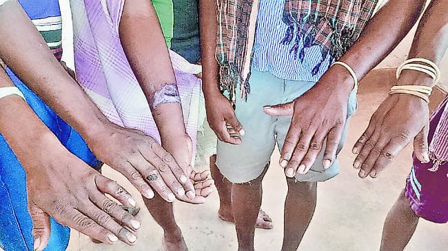 सिमडेगा में फिर फैली एंथ्रेक्स!