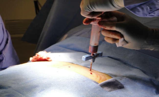 पाकिस्तानी बच्चा बना भारत में सबसे कम उम्र का अस्थिमज्जा डोनर