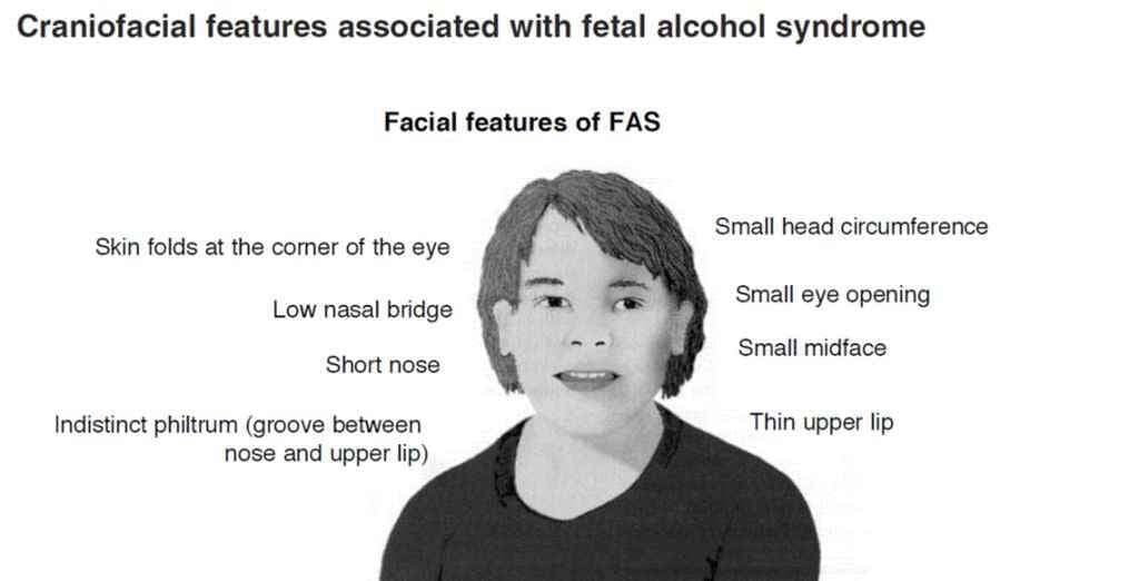 सावधान! प्रेगनेंसी में शराब से करिए तौबा