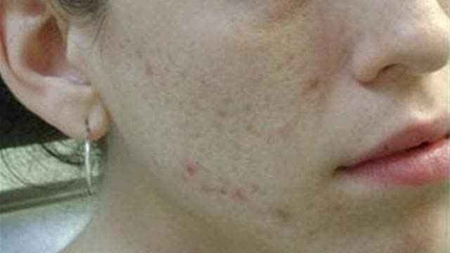 स्किन और नर्वस सिस्टम से संबंधित हानिकारक ट्यूमर का पता लगाना होगा आसान: रिसर्च