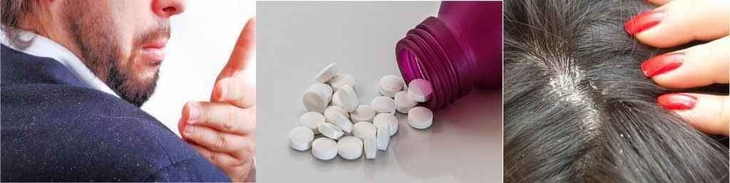 क्या डैंड्रफ है? तो ‘एस्पिरिन’ लीजिए...