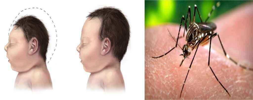 सावधान! यूरिन और थूक से भी फैल रहा है ‘जीका वायरस’