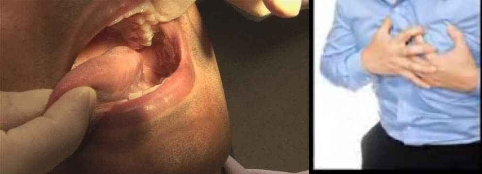 सावधान! स्ट्रोक की संभावना बढ़ा देते हैं मुंह के बैक्टीरिया