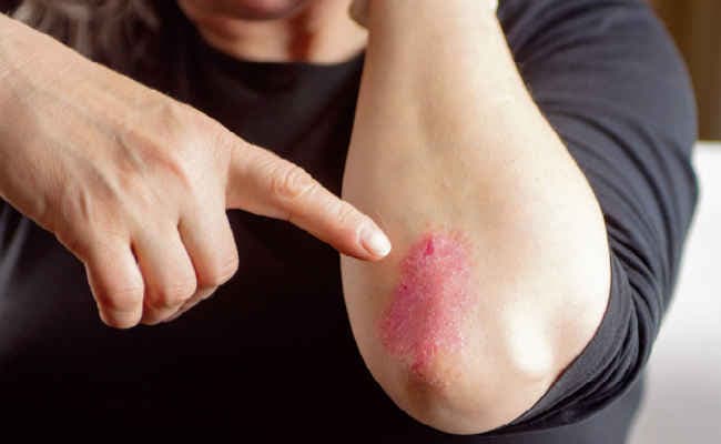 सोरायसिस से पा सकते हैं छुटकारा