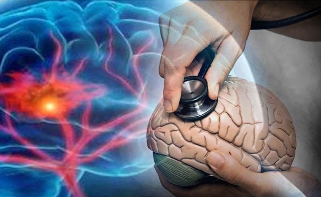 तुरंत उपचार से स्ट्रोक में रिकवरी संभव
