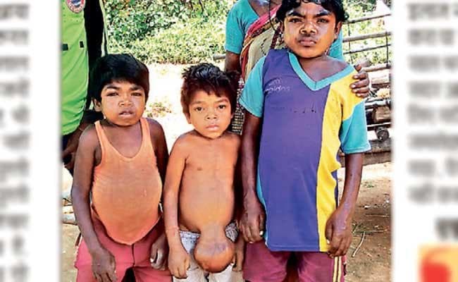 झारखंड : जानें...पेट पर डेढ़ किलो का कौन सा बीमारी लिये घूम रहा है अंजीत