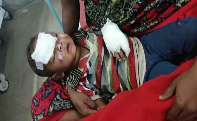 बोकारो : दो बच्चे खेलते वक्त जले, एक बोकारो रेफर
