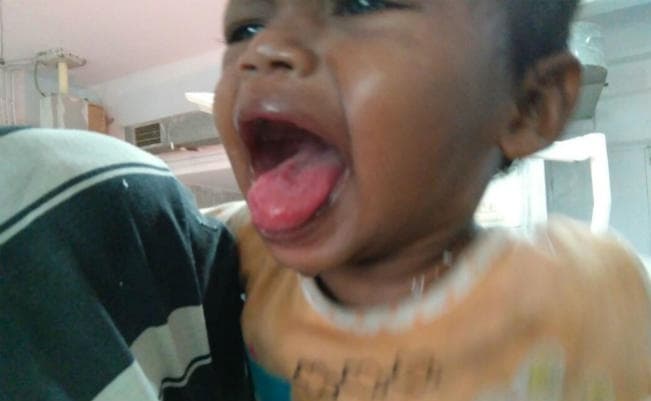 दुर्लभ बीमारी रेनुला से पीड़ित गीता सबर का रिम्स में हुआ पहले चरण का ऑपरेशन, मिली राहत