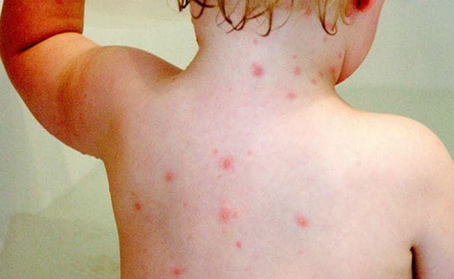 झारखंड के इन 2 जिलों में चिकन पॉक्स का अंदेशा, कई बच्चे पीड़ित, स्वास्थ्य विभाग के आदेश पर गठित हुई टीम