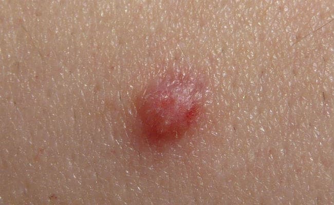 आपके बच्‍चे को कैंसर से बचायेगा HPV वैक्‍सीन की दो खुराक