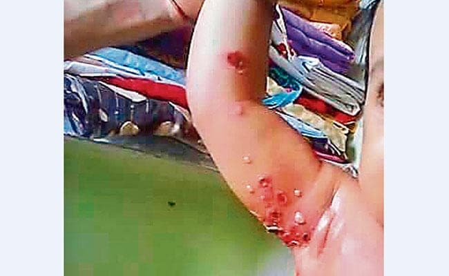 बुल्लोस इम्पेटिगो है संक्रामक रोग