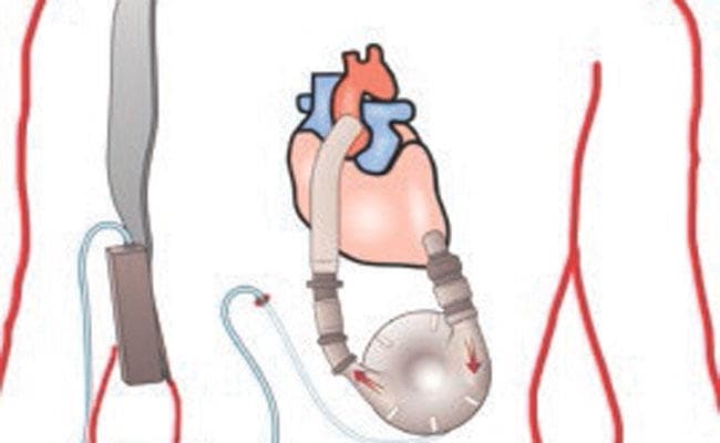 हार्ट के मरीजों की जान बचाने में सक्षम होगी, वायरलेस हार्ट पंप बैटरी